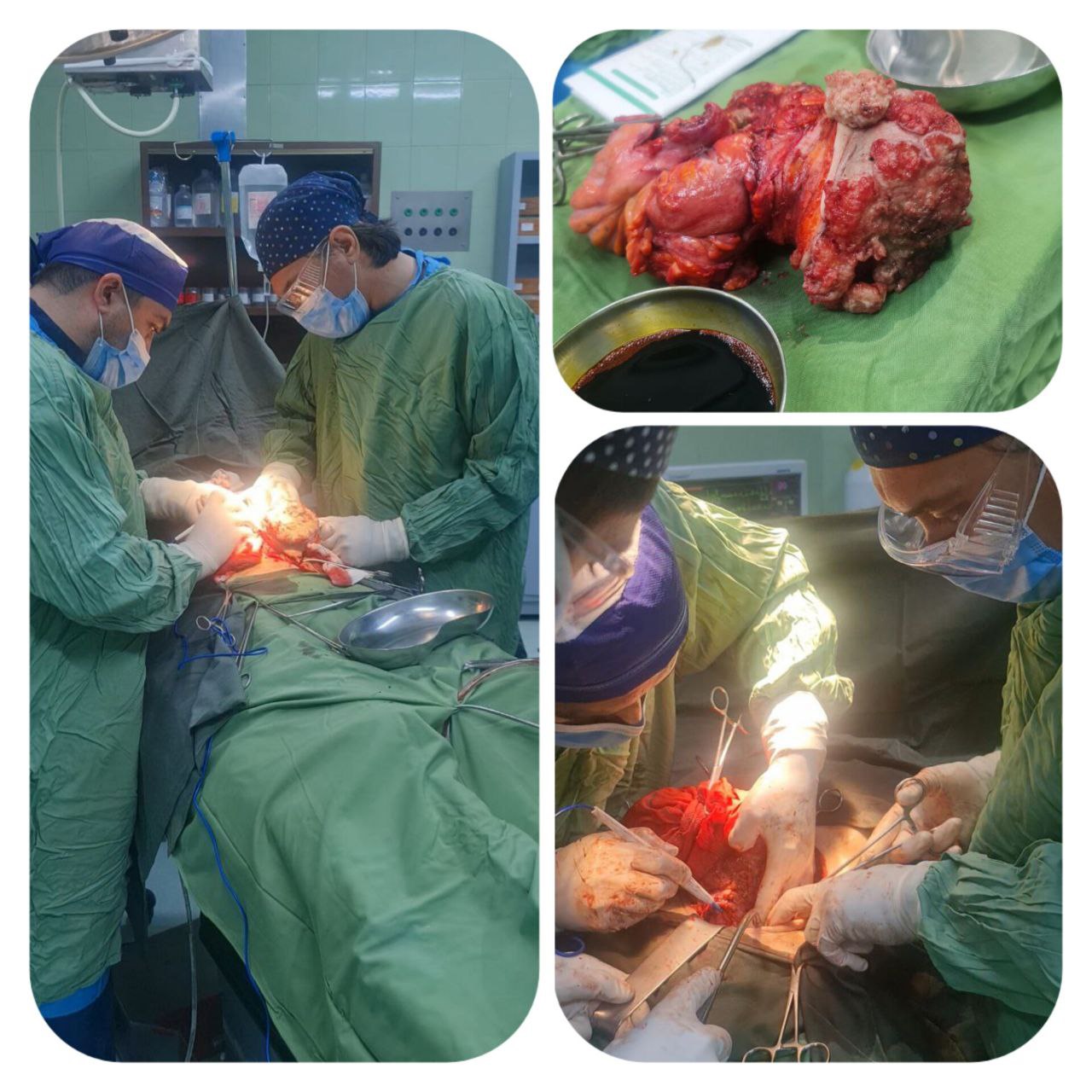 عمل جراحی برداشتن توده سرطانی لگن و درگیر با جدار شکم در بیمارستان امام خمینی درگز با موفقیت انجام شد